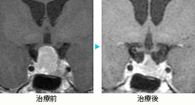 下垂体腫瘍(ホルモン非産生)1