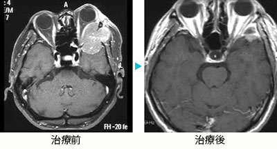 肝臓がん脳転移