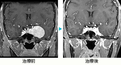 海綿状血管腫（海綿静脈洞部)