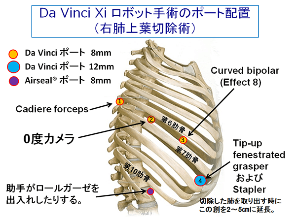 Da Vinci Xi ロボット手術のポート配置