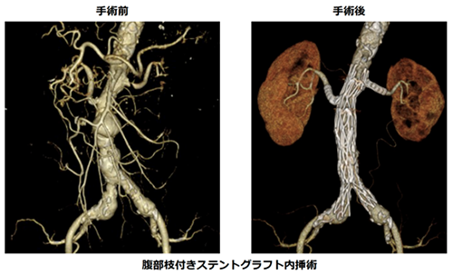 図9) 右腎動脈の部位に自作開窓したステントグラフト内挿術(fenestrated EVAR)