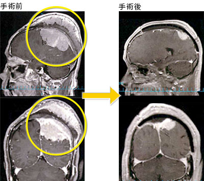 髄膜腫1.左頭頂部髄膜腫