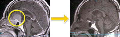 髄膜腫-10 鞍結節髄膜腫