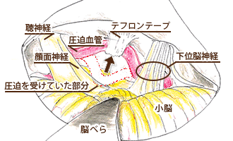 右顔面痙攣の治療のイラスト