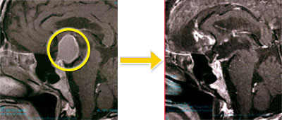 トルコ鞍部腫瘍-1 頭蓋咽頭