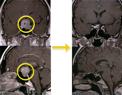 トルコ鞍部腫瘍-5 下垂体腺腫（非ホルモン産生腺腫）