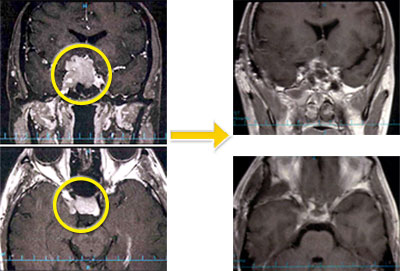 トルコ鞍部腫瘍-6 下垂体腺腫