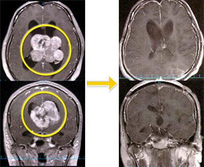 脳室内腫瘍-1 髄膜腫