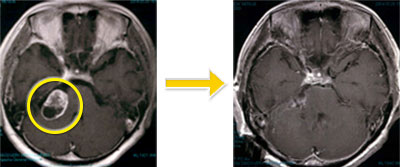 神経鞘腫-1 右聴神経鞘腫