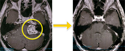 神経鞘腫-3 左聴神経鞘腫