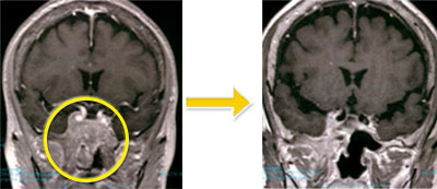 頭蓋底腫瘍-7 両側副鼻腔髄膜腫