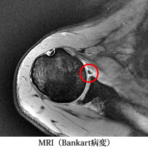 Bankart病変（MRI）