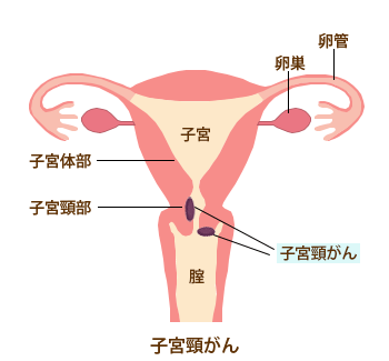 子宮頸がん