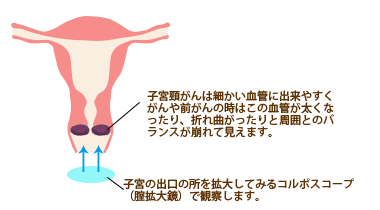 コルポスコープ