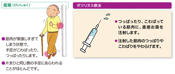 ボツリヌス療法とは