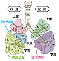 呼吸器外科の疾患と治療法