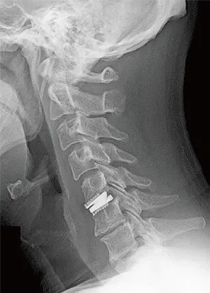 人工椎間板置換術