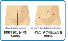 低侵襲ロボット支援手術の特長
