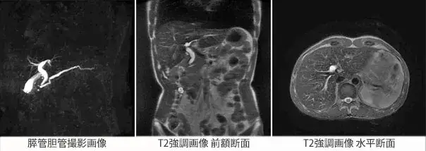 脊椎MRI画像