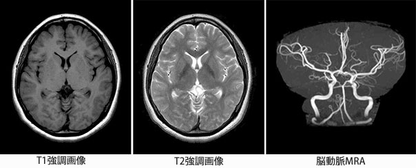 脳MRI画像