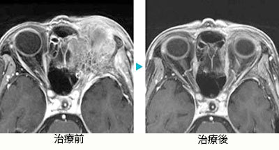 肺がん眼窩部転移