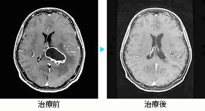 卵巣がん転移性脳腫瘍