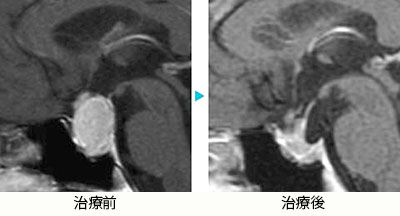 下垂体腫瘍(ホルモン非産生)2