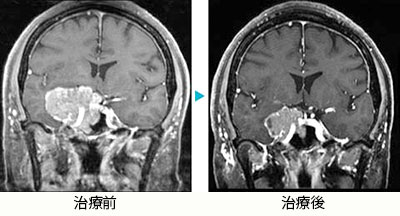 下垂体腫瘍(ホルモン非産生)3