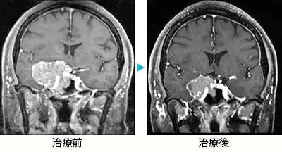 下垂体腫瘍(ホルモン非産生)3