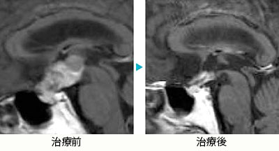 頭蓋咽頭腫1