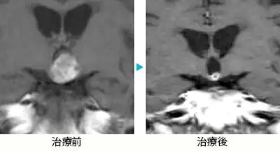 頭蓋咽頭腫2