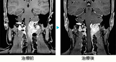 髄膜腫(大孔部)