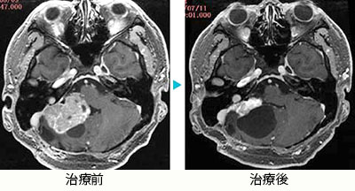 小脳血管芽腫1