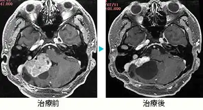 小脳血管芽腫1