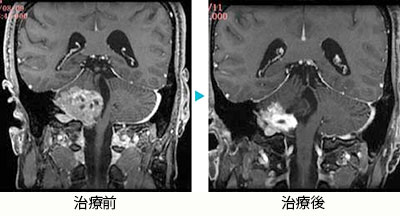 小脳血管芽腫2