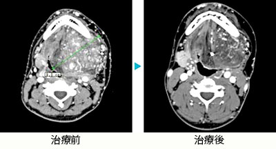 舌動静脈奇形