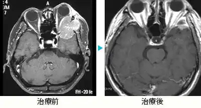 肝臓がん脳転移