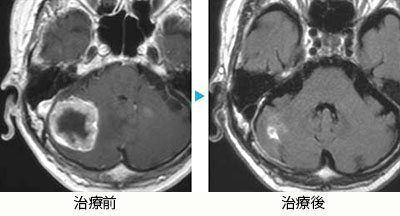 肺腺癌小脳転移