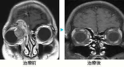 副鼻腔悪性黒色腫