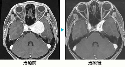 海綿状血管腫（海綿静脈洞部)