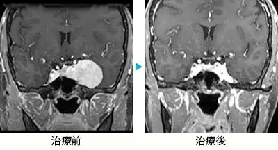 海綿状血管腫（海綿静脈洞部)