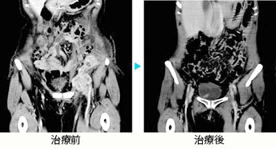 卵巣がん骨盤内転移