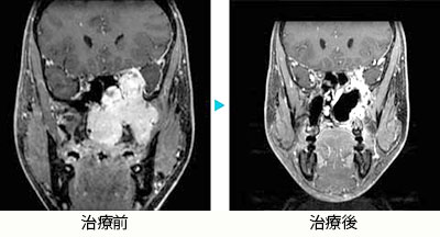 若年性鼻咽頭血管繊維腫