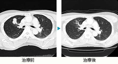 転移性肺がん（直腸がん）