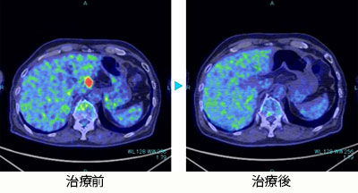 肝臓がん腹部リンパ節転移　60代男性