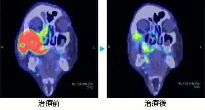 上顎がん 70代男性