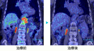 胃がん腹部リンパ節転移 70代女性