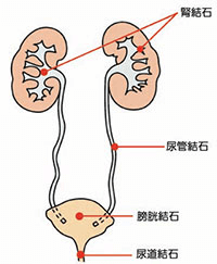 尿路結石解説図