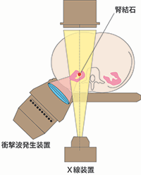 体外衝撃波結石破砕装置ドルニエの特長