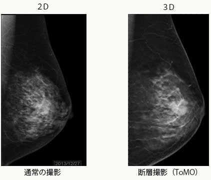 通常(2D)とデジタルトモシンセシス(3D)1